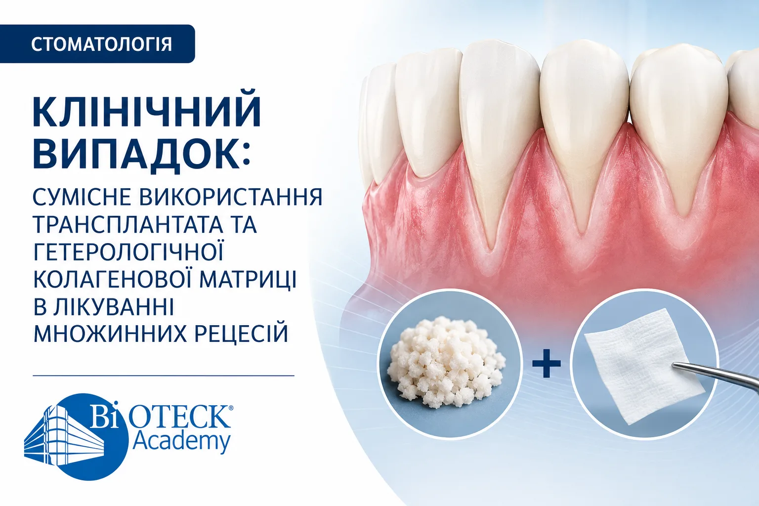 Лікування множинних рецесій: клінічний випадок