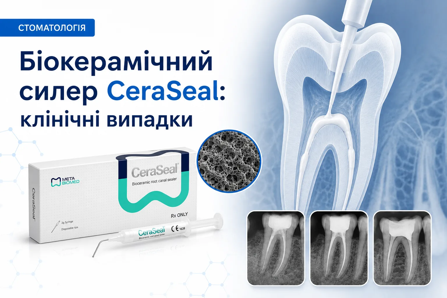 Біокерамічний силер CeraSeal: клінічні випадки