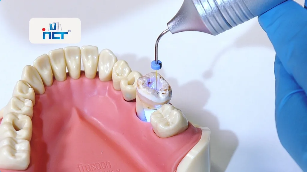 Dental training model of the upper jaw; a gloved hand uses a dental instrument to treat a molar with a small blue spacer and light/laser tip.