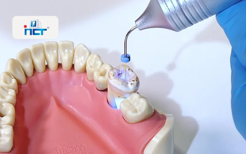 Dental training model of the upper jaw; a gloved hand uses a dental instrument to treat a molar with a small blue spacer and light/laser tip.